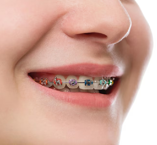 Orthodontics Braces & Clip